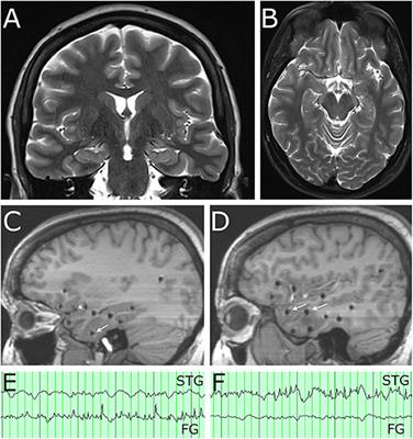 Robot Assisted MRI-Guided LITT of the Anterior, Lateral, and Medial Temporal Lobe for Temporal Lobe Epilepsy